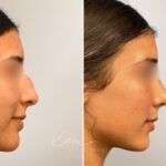 Rhinoplasty before and after photos in Voorhees, NJ, Patient 5029
