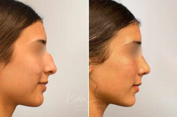 Rhinoplasty before and after photos in Voorhees, NJ, Patient 5029