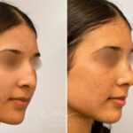 Rhinoplasty before and after photos in Voorhees, NJ, Patient 5029