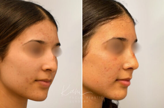 Rhinoplasty before and after photos in Voorhees, NJ, Patient 5029