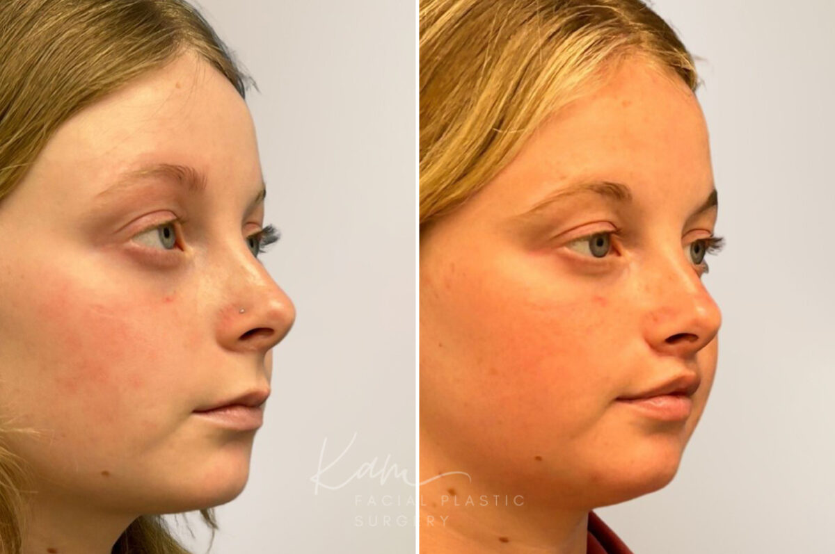 Lip Lift before and after photos in Voorhees, NJ, Patient 5040