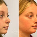 Lip Lift before and after photos in Voorhees, NJ, Patient 5040