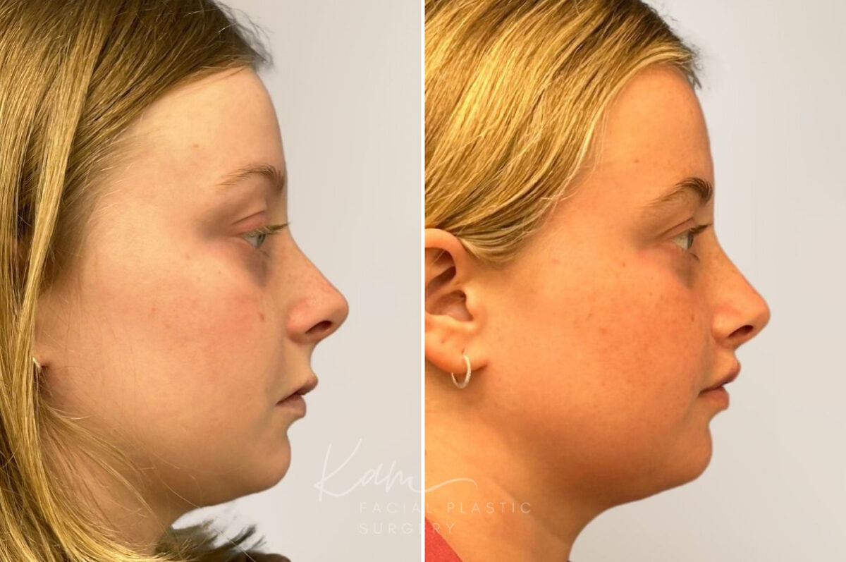 Lip Lift before and after photos in Voorhees, NJ, Patient 5040