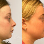 Lip Lift before and after photos in Voorhees, NJ, Patient 5040