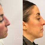 Rhinoplasty before and after photos in Voorhees, NJ, Patient 5047