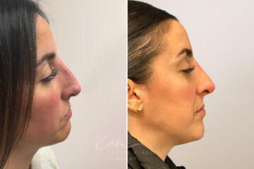 Rhinoplasty before and after photos in Voorhees, NJ, Patient 5047