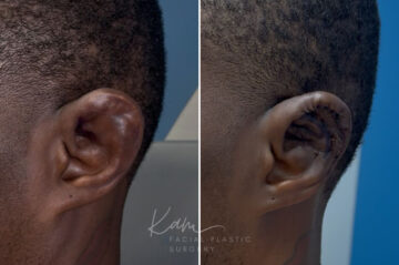 Otoplasty before and after photos in Voorhees, NJ, Patient 5087