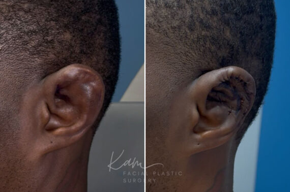 Otoplasty before and after photos in Voorhees, NJ, Patient 5087